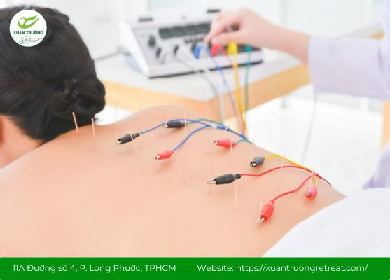 Điều trị đau lưng do hàn thấp bằng châm cứu vùng thắt lưng