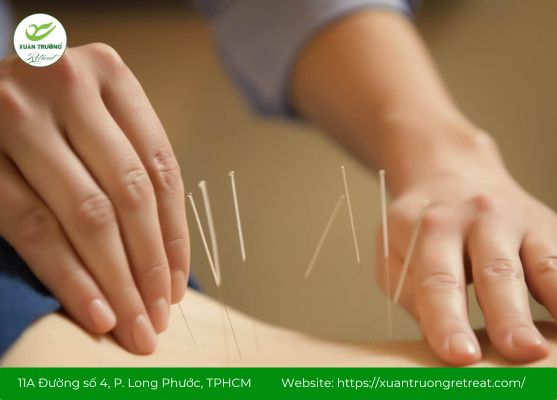 châm cứu chữa đau lưng