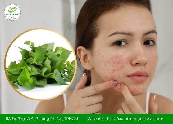 Rau diếp cá trị mụn