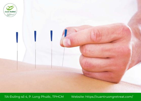 Châm cứu huyệt Tý Nhu giúp giảm đau vai, cổ