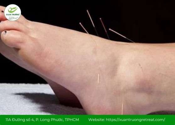 Châm cứu và day ấn huyệt Chiếu Hải đúng kỹ thuật